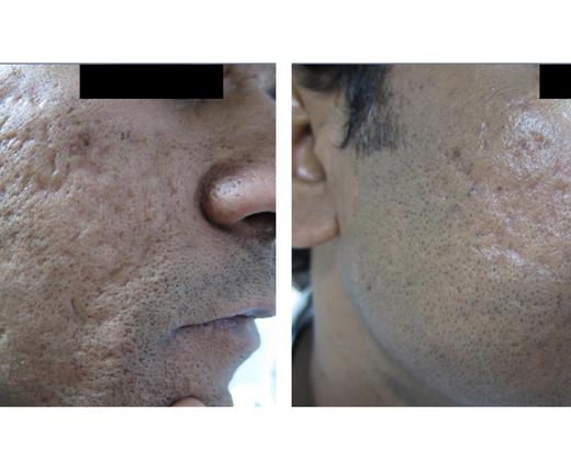 Лазер Asclepion MCL31 Dermablate ➜ Профессиональное лазерное омоложение, купить в Украине | Alfaspa изображение 28