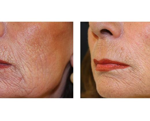 Лазер Asclepion MCL31 Dermablate ➜ Профессиональное лазерное омоложение, купить в Украине | Alfaspa изображение 29