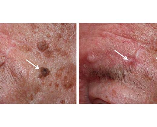 Лазер Asclepion MCL31 Dermablate ➜ Профессиональное лазерное омоложение, купить в Украине | Alfaspa изображение 30