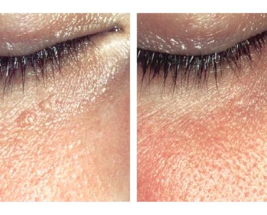 Лазер Asclepion MCL31 Dermablate ➜ Профессиональное лазерное омоложение, купить в Украине | Alfaspa изображение 31