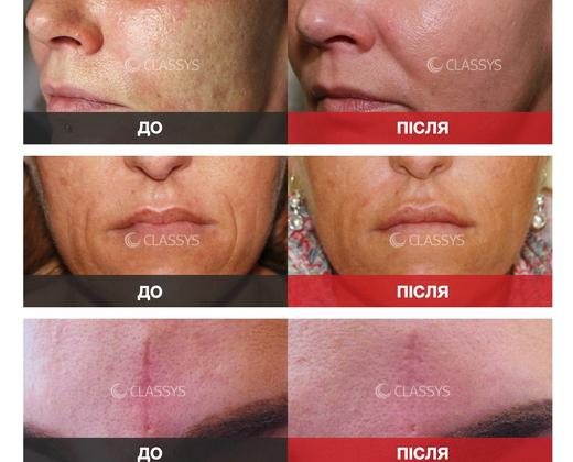 Classys Secret RF: Апарат фракційного RF-ліфтингу ➔ купити в Україні | Alfaspa зображення 26