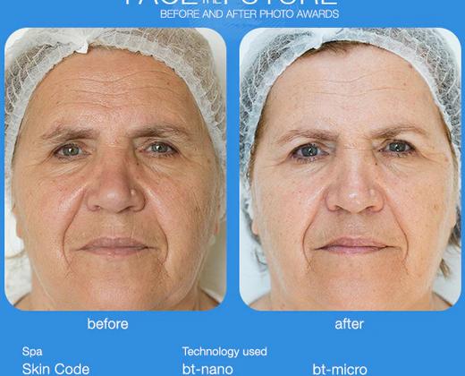 Купити ультразвуковий брашинг bt-sonic | Alfaspa зображення 17