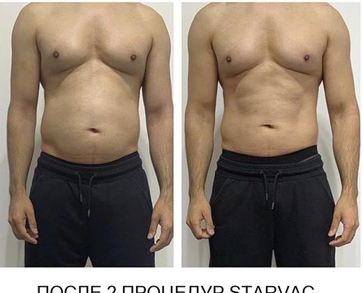 Starvac DX Focus - Купити в Україні | Alfaspa зображення 22