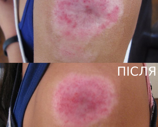 Classys FRAXIS DUO ➔ Апарат фракційного CO2 та мікроголкового лазера в Україні | Alfaspa зображення 33