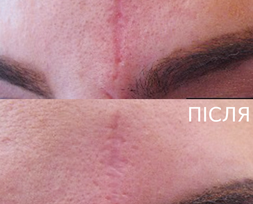 Classys FRAXIS DUO ➔ Апарат фракційного CO2 та мікроголкового лазера в Україні | Alfaspa зображення 34