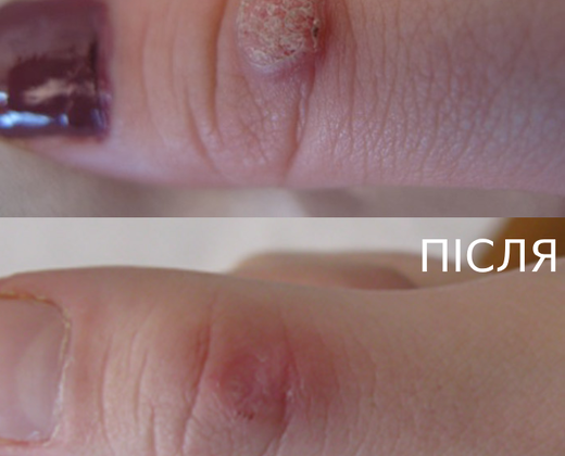 Classys FRAXIS DUO ➔ Апарат фракційного CO2 та мікроголкового лазера в Україні | Alfaspa зображення 35