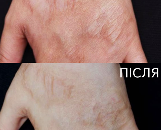 Classys FRAXIS DUO ➔ Апарат фракційного CO2 та мікроголкового лазера в Україні | Alfaspa зображення 36