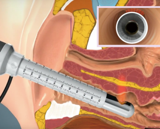 Classys FRAXIS DUO ➔ Апарат фракційного CO2 та мікроголкового лазера в Україні | Alfaspa зображення 37