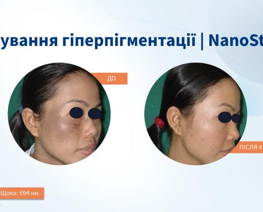 Asclepion NanoStar C для удаления тату ➜ Купить лазер для удаления татуажа в Украине | Alfaspa изображение 39