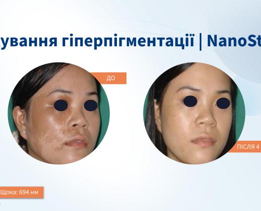 Asclepion NanoStar C для удаления тату ➜ Купить лазер для удаления татуажа в Украине | Alfaspa изображение 38