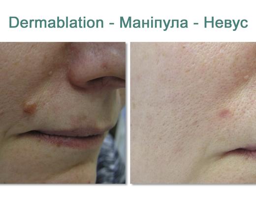 Asclepion MultiPulse PRO ➜ Профессиональный CO2 лазер в Украине | Alfaspa изображение 30