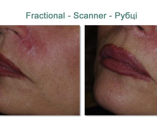 Asclepion MultiPulse PRO ➜ Профессиональный CO2 лазер в Украине | Alfaspa изображение 34