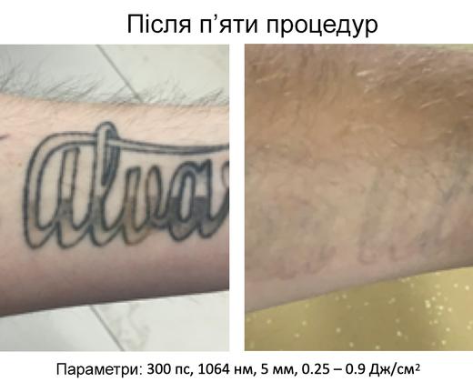 Пікосекундний лазер для видалення тату Asclepion PicoStar ➔ купити в Україні | Alfaspa зображення 44