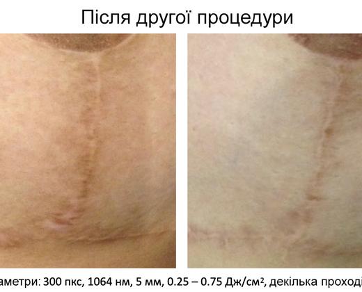 Пікосекундний лазер для видалення тату Asclepion PicoStar ➔ купити в Україні | Alfaspa зображення 45