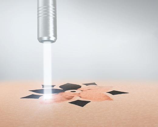 Пікосекундний лазер для видалення тату Asclepion PicoStar ➔ купити в Україні | Alfaspa зображення 41