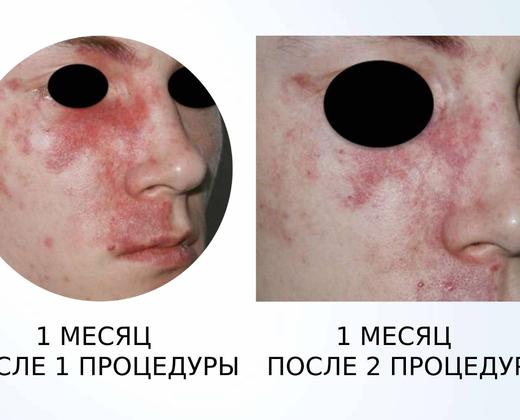 Жовтий лазер Asclepion QuadrostarPRO Yellow 577нм ➔ купити в Україні | Alfaspa зображення 37