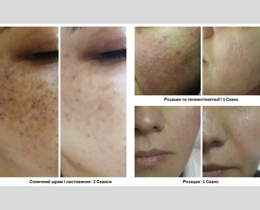 Classys ilooda SUPER VELOCE 4800: Апарат для фотоомолодження ➔ купити в Україні | Alfaspa зображення 24