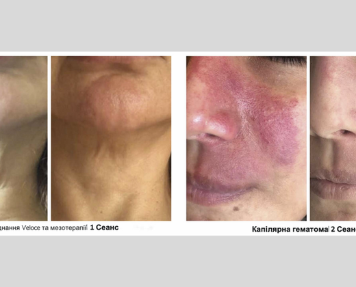 Classys ilooda SUPER VELOCE 4800: Апарат для фотоомолодження ➔ купити в Україні | Alfaspa зображення 25