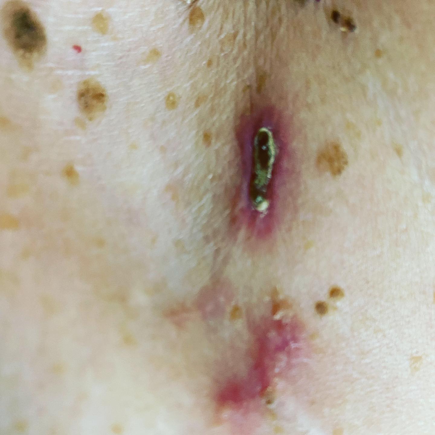 Александр Туркевич рекомендует Asclepion MCL31 Dermablate | Alfaspa изображение 3