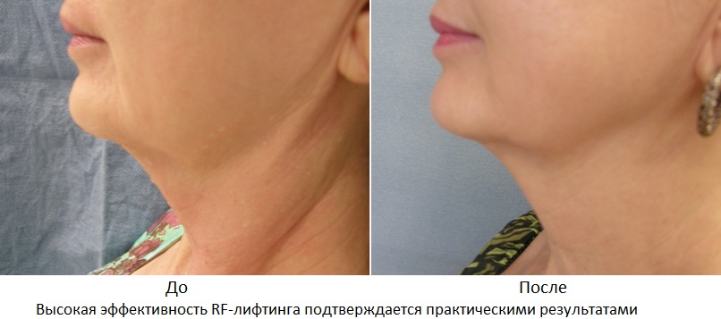 Профессиональный RF-лифтинг – действенная замена подтяжки кожи хирургическим методом | Alfaspa изображение 2