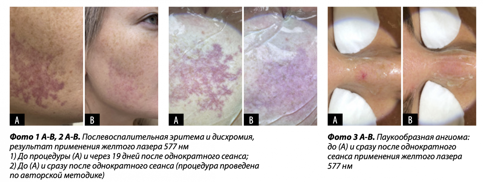 Лазерная коррекция сосудистых патологий и пигментации | Alfaspa изображение 2