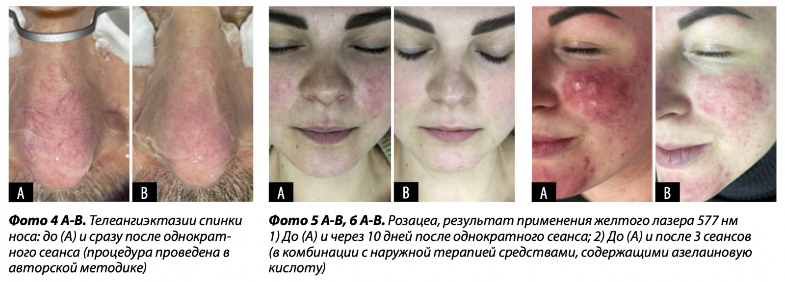 Лазерная коррекция сосудистых патологий и пигментации | Alfaspa изображение 3