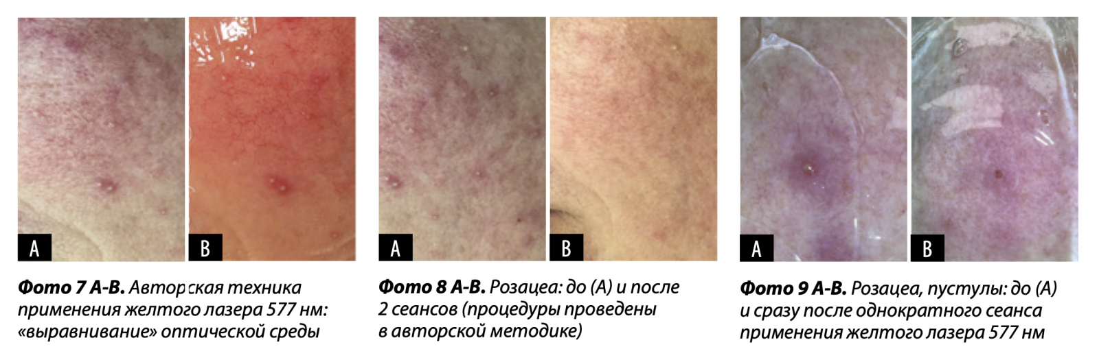 Лазерная коррекция сосудистых патологий и пигментации | Alfaspa изображение 4