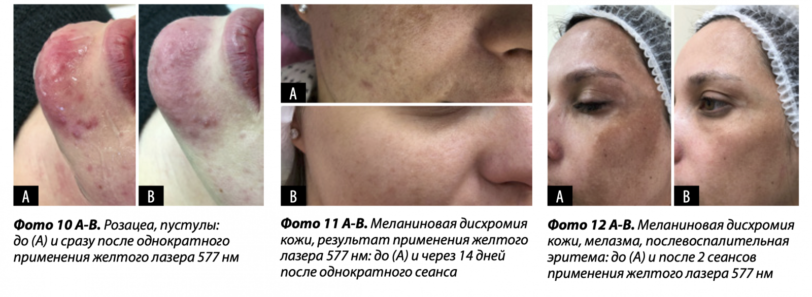 Лазерная коррекция сосудистых патологий и пигментации | Alfaspa изображение 5