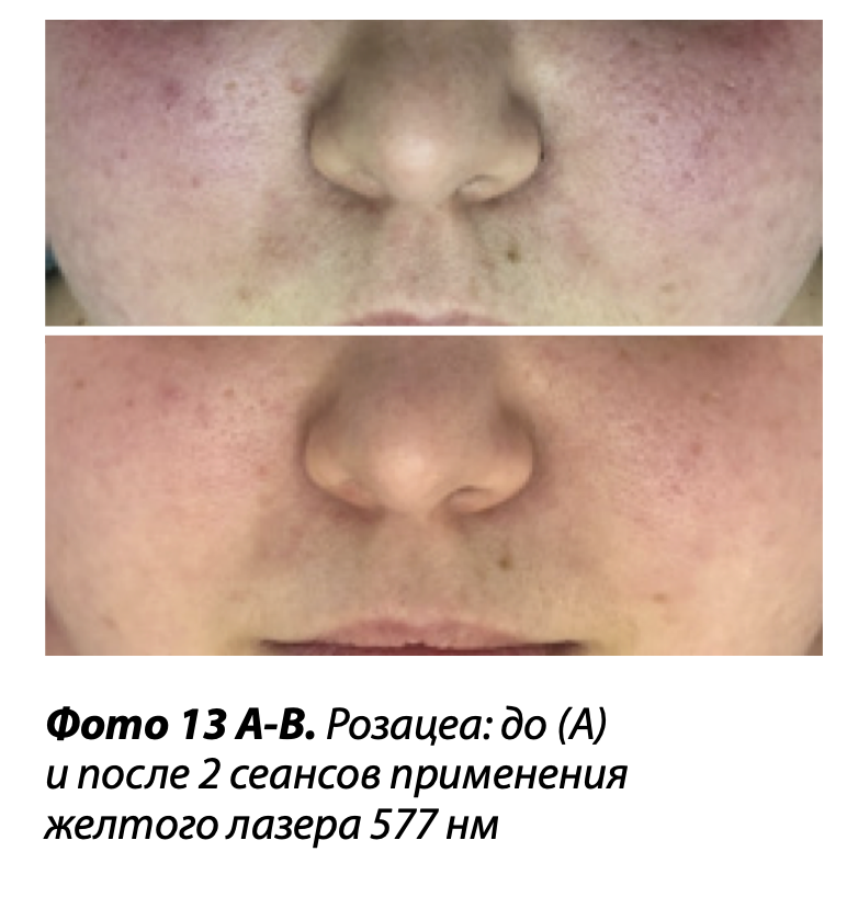 Лазерная коррекция сосудистых патологий и пигментации | Alfaspa изображение 6