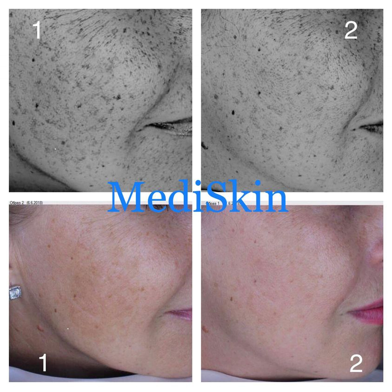 Идеальная кожа: все, что нужно знать о куперозе, пигментации и удалении сосудов | Alfaspa изображение 12