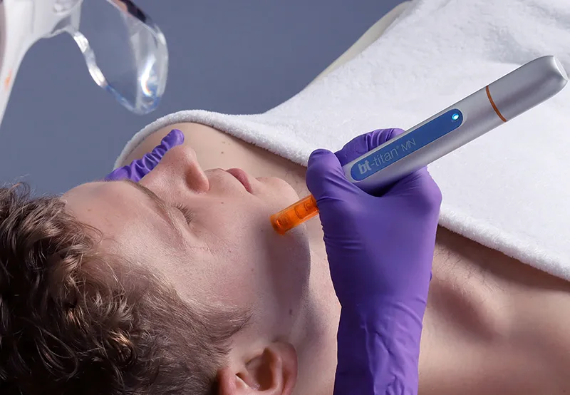 Мезотерапия для лица: виды, преимущества, показания и эффективность | AlfaSpa | Alfaspa изображение 4