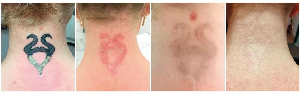 Безопасное и эффективное лазерное удаление татуировки с помощью нового типа пикосекундного лазера с двумя длинами волн | Alfaspa изображение 1