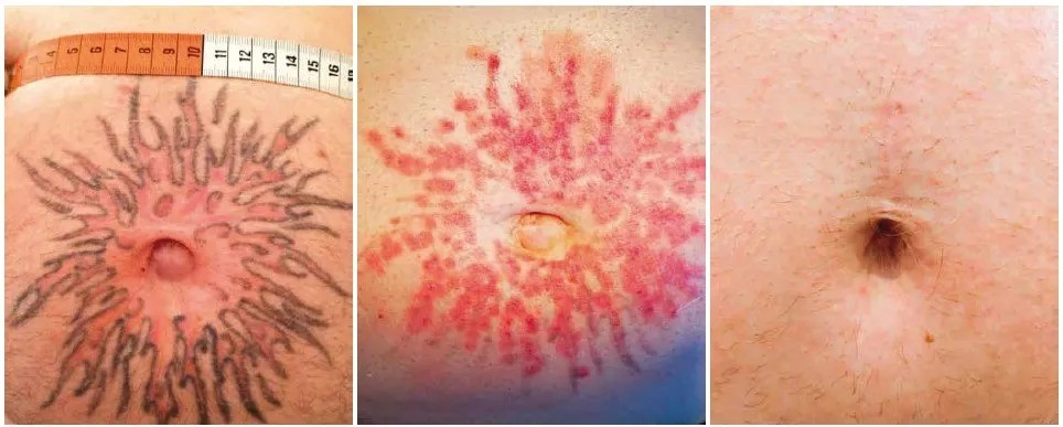 Безопасное и эффективное лазерное удаление татуировки с помощью нового типа пикосекундного лазера с двумя длинами волн | Alfaspa изображение 2