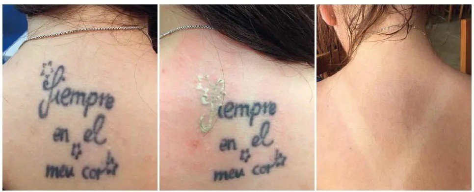 Безопасное и эффективное лазерное удаление татуировки с помощью нового типа пикосекундного лазера с двумя длинами волн | Alfaspa изображение 4