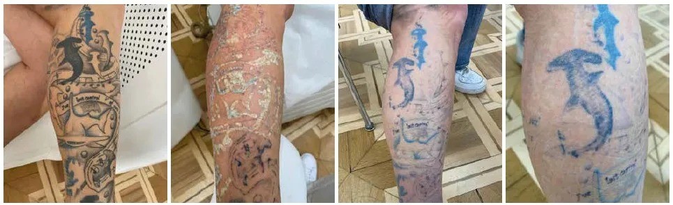 Безопасное и эффективное лазерное удаление татуировки с помощью нового типа пикосекундного лазера с двумя длинами волн | Alfaspa изображение 3