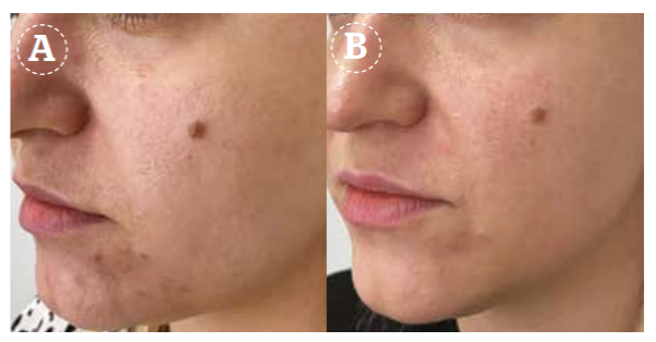 Исследование применения лазера ER:GLASS Secret DUO с целью омоложения кожи | Alfaspa изображение 2