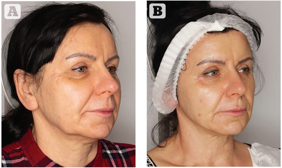 Результаты SECRET DUO SmartCure: Подтяжка кожи шеи и подбородка | Alfaspa изображение 2