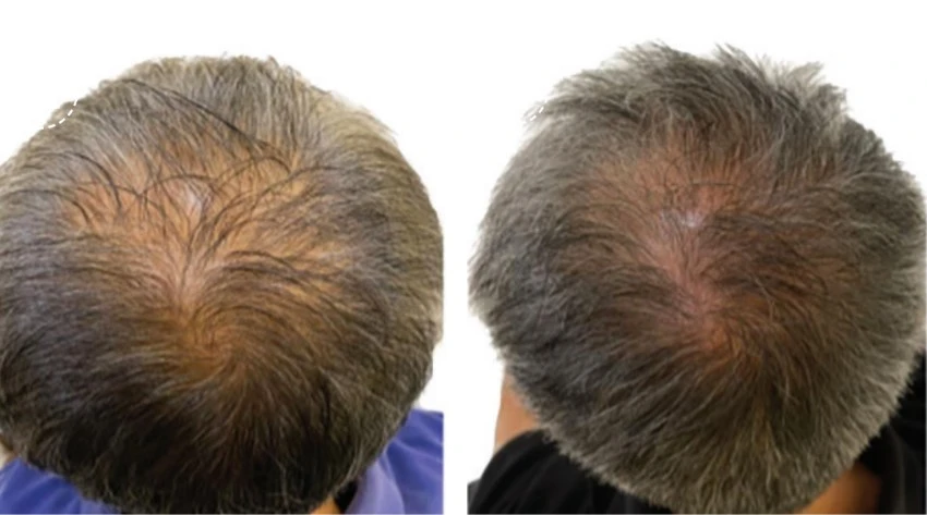 Исследование Сина Йонга Эффективности Эрбиевого Лазера для Роста Волос. | Alfaspa изображение 2