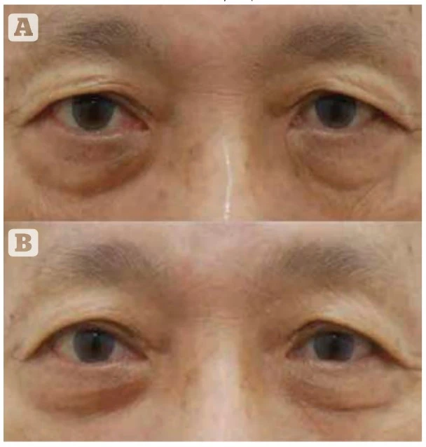 Secret Duo от ilooda - Эффективное лечение мешков под глазами. | Alfaspa изображение 2