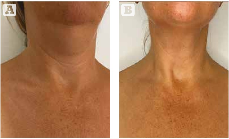 SUPER VELOCE: Минимальные побочные эффекты | Д-р Петра Мецярова | Alfaspa изображение 2