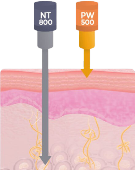 SUPER VELOCE 4800 – удаление недостатков, лечение кожи и лифтинг на одном аппарате | Alfaspa изображение 2
