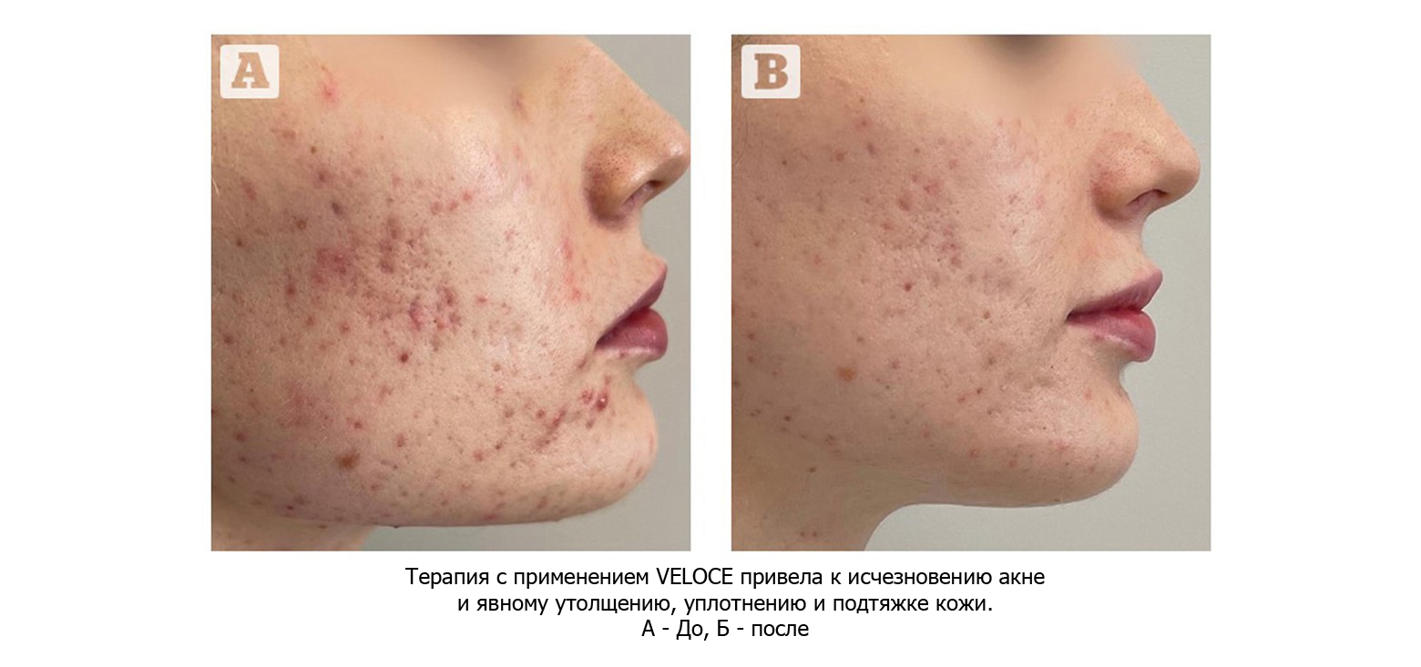 Исследование технологии IPDL VELOCE для лечения акне, рубцов после акне и подтяжки кожи | Alfaspa изображение 2