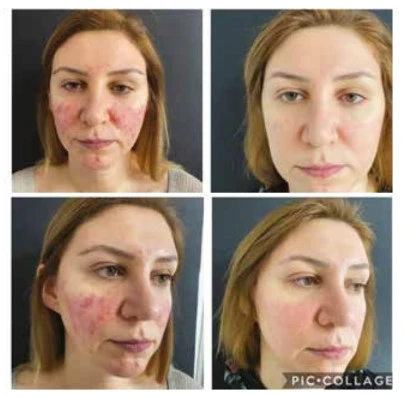 Исследование IPDL SUPER VELOCE: Эффективное лечение акне и покраснений | Alfaspa изображение 2