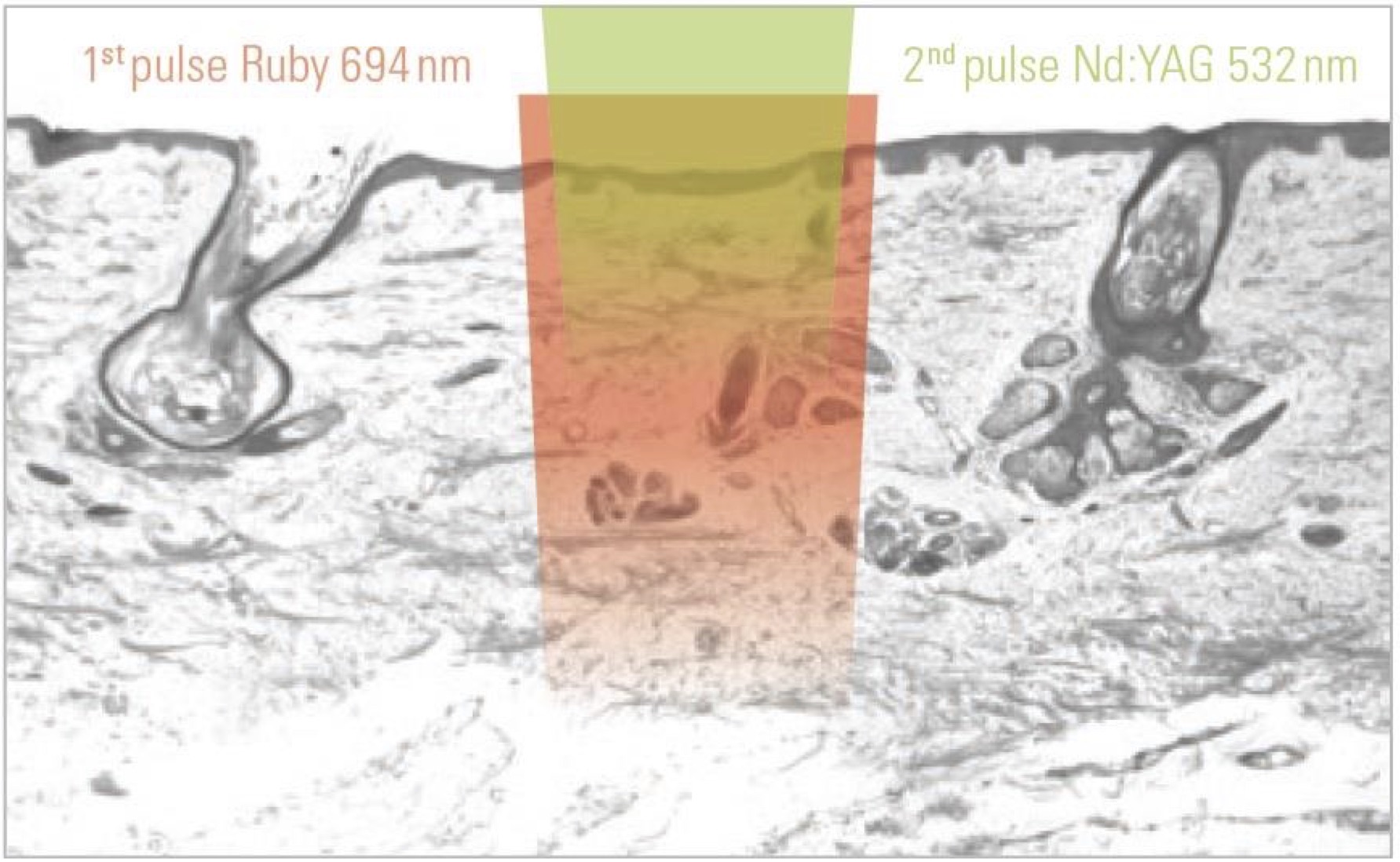 Asclepion NanoStar C для удаления тату ➜ Купить лазер для удаления татуажа в Украине | Alfaspa изображение 18