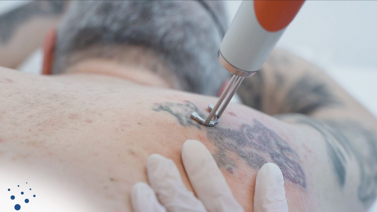 Asclepion NanoStar C для удаления тату ➜ Купить лазер для удаления татуажа в Украине | Alfaspa изображение 50