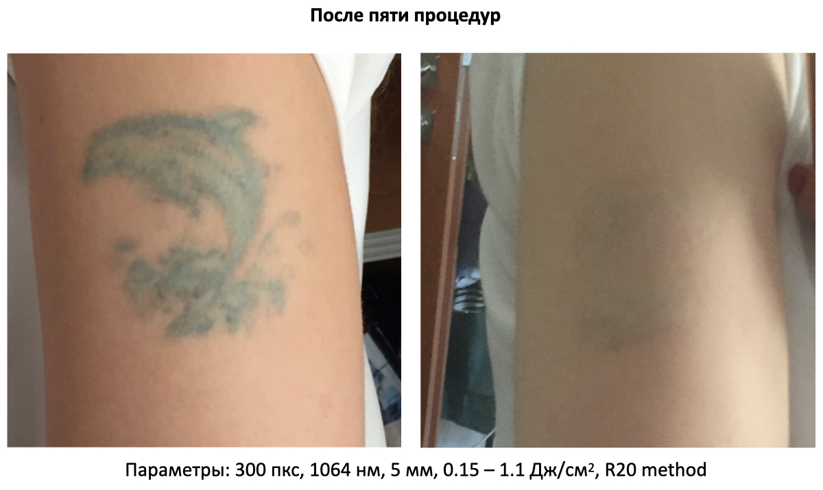 Пикосекундный лазер для удаления тату Asclepion PicoStar ➔ купить в Украине | Alfaspa изображение 21