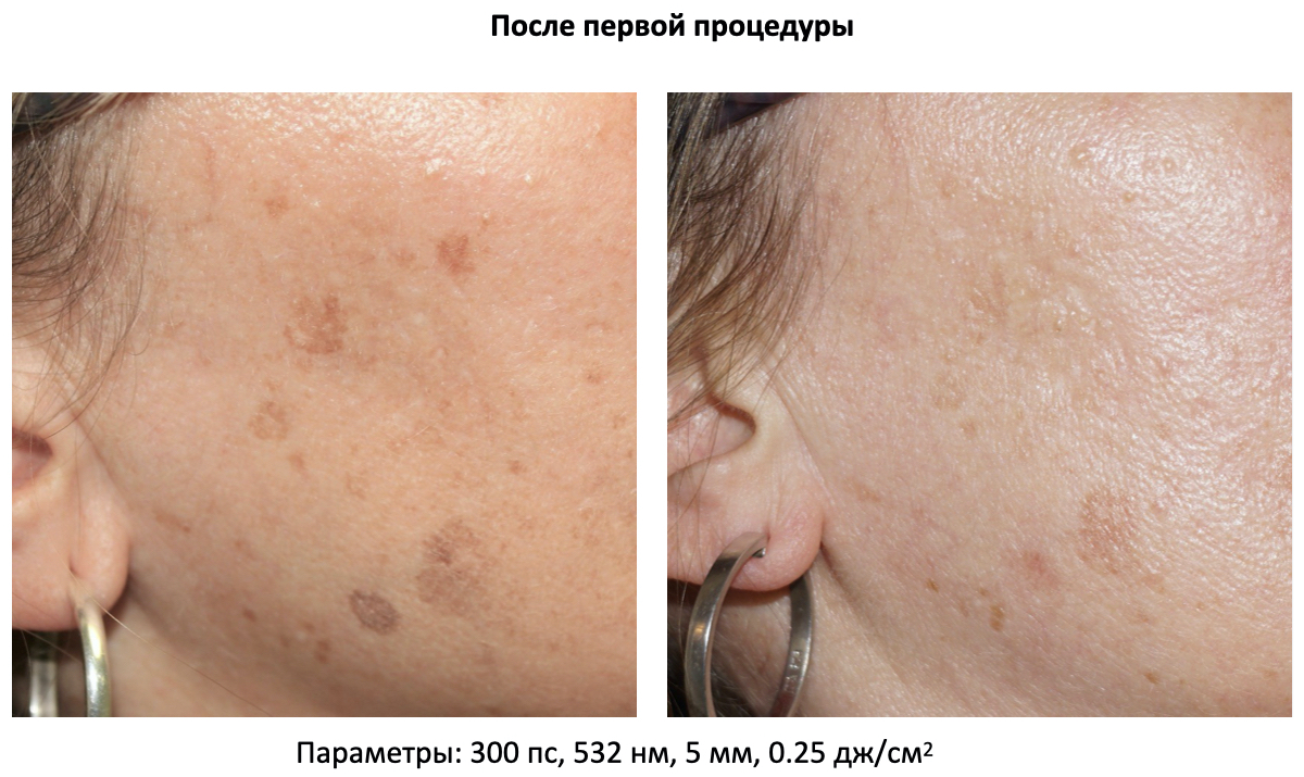 Пикосекундный лазер для удаления тату Asclepion PicoStar ➔ купить в Украине | Alfaspa изображение 22