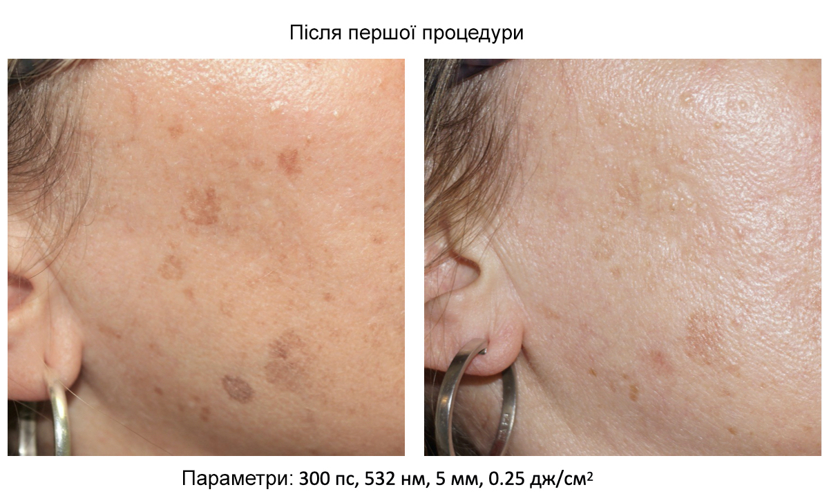 Пікосекундний лазер для видалення тату Asclepion PicoStar ➔ купити в Україні | Alfaspa зображення 22