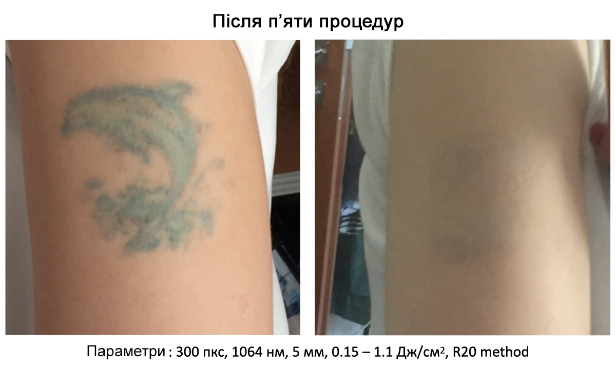 Пікосекундний лазер для видалення тату Asclepion PicoStar ➔ купити в Україні | Alfaspa зображення 21