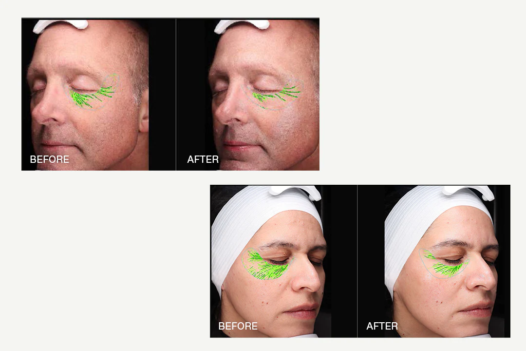 BT-Sculpt GEN2: Обладнання Bio-Therapeutic | Alfaspa зображення 16